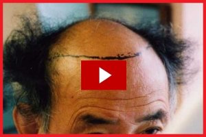 Hair Loss Protocol videos